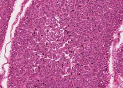 Immunohistochemistry-Paraffin: Human Bladder Tissue MicroArray (Cancer) [NBP3-11846] - 26. Urothelial carcincoma