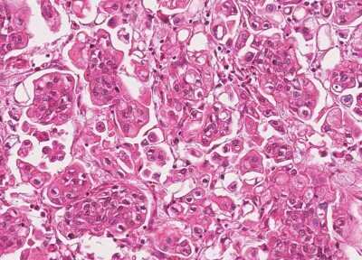 Immunohistochemistry-Paraffin: Human Bladder Tissue MicroArray (Cancer) [NBP3-11846] - 27. Urothelial carcincoma