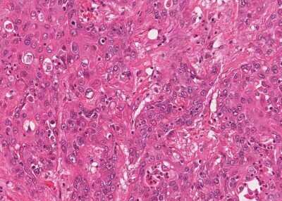 Immunohistochemistry-Paraffin: Human Bladder Tissue MicroArray (Cancer) [NBP3-11846] - 28. Urothelial carcincoma