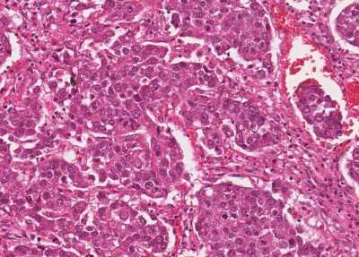 Immunohistochemistry-Paraffin: Human Bladder Tissue MicroArray (Cancer) [NBP3-11846] - Urothelial carcincoma