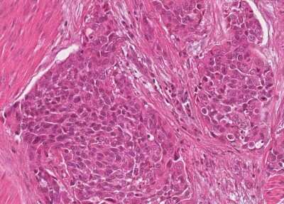 Immunohistochemistry-Paraffin: Human Bladder Tissue MicroArray (Cancer) [NBP3-11846] - 30. Urothelial carcincoma