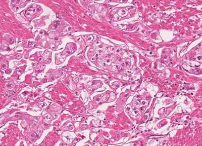 Immunohistochemistry-Paraffin: Human Bladder Tissue MicroArray (Cancer) [NBP3-11846] - 31. Urothelial carcincoma