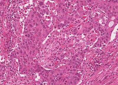 Immunohistochemistry-Paraffin: Human Bladder Tissue MicroArray (Cancer) [NBP3-11846] - 32. Urothelial carcincoma