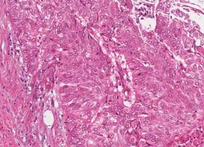 Immunohistochemistry-Paraffin: Human Bladder Tissue MicroArray (Cancer) [NBP3-11846] - 33. Urothelial carcincoma