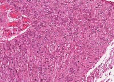 Immunohistochemistry-Paraffin: Human Bladder Tissue MicroArray (Cancer) [NBP3-11846] - 34. Urothelial carcincoma