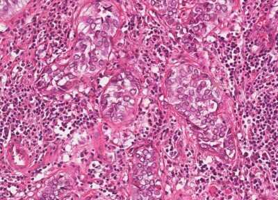 Immunohistochemistry-Paraffin: Human Bladder Tissue MicroArray (Cancer) [NBP3-11846] - 35. Urothelial carcincoma