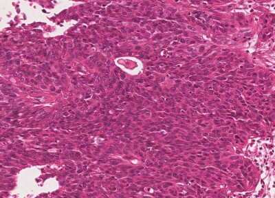 Immunohistochemistry-Paraffin: Human Bladder Tissue MicroArray (Cancer) [NBP3-11846] - 36. Urothelial carcincoma