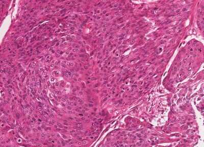 Immunohistochemistry-Paraffin: Human Bladder Tissue MicroArray (Cancer) [NBP3-11846] - 37. Urothelial carcincoma