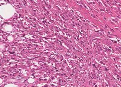 Immunohistochemistry-Paraffin: Human Bladder Tissue MicroArray (Cancer) [NBP3-11846] - 38. Urothelial carcincoma