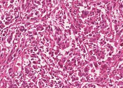 Immunohistochemistry-Paraffin: Human Bladder Tissue MicroArray (Cancer) [NBP3-11846] - 39. Urothelial carcincoma