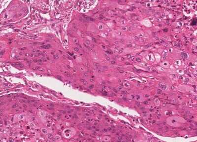 Immunohistochemistry-Paraffin: Human Bladder Tissue MicroArray (Cancer) [NBP3-11846] - 40. Urothelial carcincoma