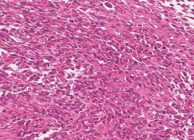 Immunohistochemistry-Paraffin: Human Bladder Tissue MicroArray (Cancer) [NBP3-11846] - 41. Urothelial carcincoma