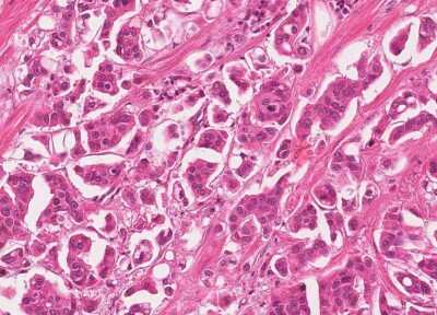 Immunohistochemistry-Paraffin: Human Bladder Tissue MicroArray (Cancer) [NBP3-11846] - 42. Urothelial carcincoma