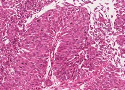 Immunohistochemistry-Paraffin: Human Bladder Tissue MicroArray (Cancer) [NBP3-11846] - 43. Urothelial carcincoma