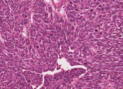 Immunohistochemistry-Paraffin: Human Bladder Tissue MicroArray (Cancer) [NBP3-11846] - 44. Urothelial carcincoma