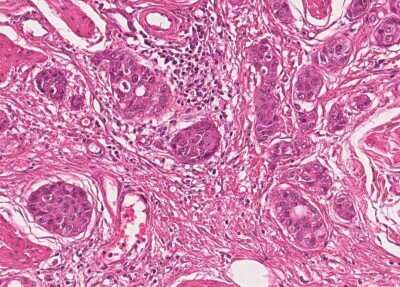 Immunohistochemistry-Paraffin: Human Bladder Tissue MicroArray (Cancer) [NBP3-11846] - 45. Urothelial carcincoma