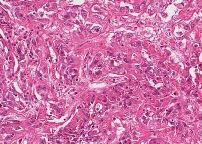 Immunohistochemistry-Paraffin: Human Bladder Tissue MicroArray (Cancer) [NBP3-11846] - 46. Urothelial carcincoma