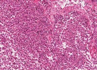 Immunohistochemistry-Paraffin: Human Bladder Tissue MicroArray (Cancer) [NBP3-11846] - 47. Urothelial carcincoma