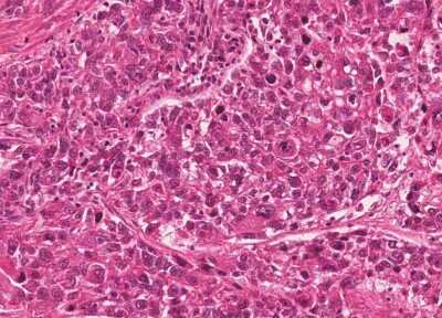 Immunohistochemistry-Paraffin: Human Bladder Tissue MicroArray (Cancer) [NBP3-11846] - 48. Urothelial carcincoma