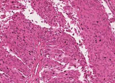 Immunohistochemistry-Paraffin: Human Bladder Tissue MicroArray (Cancer) [NBP3-11846] - 49. Urothelial carcincoma