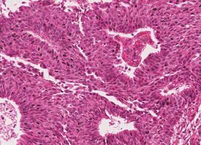 Immunohistochemistry-Paraffin: Human Bladder Tissue MicroArray (Cancer) [NBP3-11846] - 50. Urothelial carcincoma