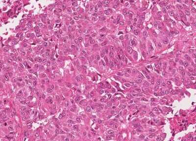 Immunohistochemistry-Paraffin: Human Bladder Tissue MicroArray (Cancer) [NBP3-11846] - 51. Urothelial carcincoma