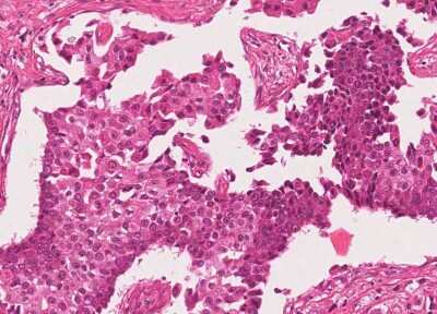 Immunohistochemistry-Paraffin: Human Bladder Tissue MicroArray (Cancer) [NBP3-11846] - 52. Urothelial carcincoma