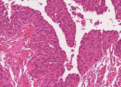 Immunohistochemistry-Paraffin: Human Bladder Tissue MicroArray (Cancer) [NBP3-11846] - 53. Urothelial carcincoma