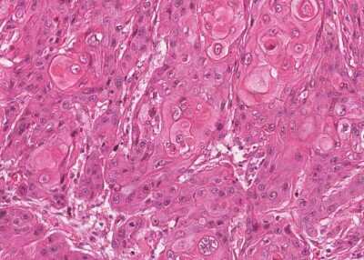 Immunohistochemistry-Paraffin: Human Bladder Tissue MicroArray (Cancer) [NBP3-11846] - 54. Squamous cell carcinoma