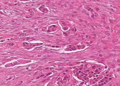 Immunohistochemistry-Paraffin: Human Bladder Tissue MicroArray (Cancer) [NBP3-11846] - 55. Urothelial carcincoma