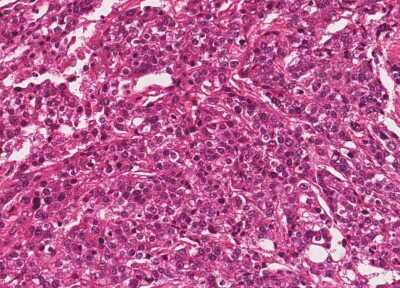 Immunohistochemistry-Paraffin: Human Bladder Tissue MicroArray (Cancer) [NBP3-11846] - 56. Urothelial carcincoma