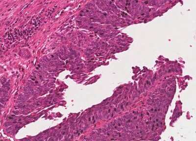 Immunohistochemistry-Paraffin: Human Bladder Tissue MicroArray (Cancer) [NBP3-11846] - 57. Urothelial carcincoma