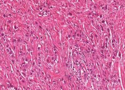 Immunohistochemistry-Paraffin: Human Bladder Tissue MicroArray (Cancer) [NBP3-11846] - 58. Urothelial carcincoma