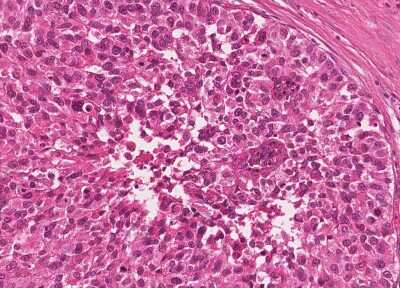 Immunohistochemistry-Paraffin: Human Bladder Tissue MicroArray (Cancer) [NBP3-11846] - 59. Urothelial carcincoma