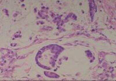 Hematoxylin & Eosin Stain: Human Common Tissue MicroArray (Cancer) [NBP2-30262] -  05. Stomach Adenocarcinoma