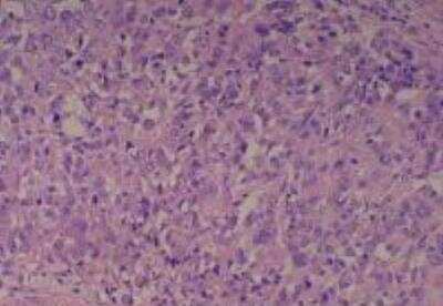 Hematoxylin & Eosin Stain: Human Common Tissue MicroArray (Cancer) [NBP2-30262] -  09. Stomach signet ring cell carcinoma