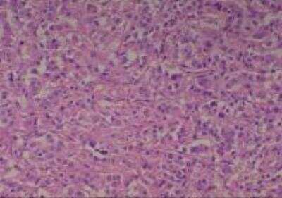 Hematoxylin & Eosin Stain: Human Common Tissue MicroArray (Cancer) [NBP2-30262] - 11. Esophagus adenocarcinoma