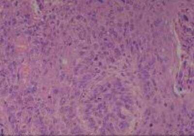 Hematoxylin & Eosin Stain: Human Common Tissue MicroArray (Cancer) [NBP2-30262] - 13. Esophagus squamous cell carcinoma