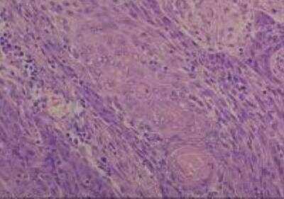 Hematoxylin & Eosin Stain: Human Common Tissue MicroArray (Cancer) [NBP2-30262] - 17. Esophagus squamous cell carcinoma