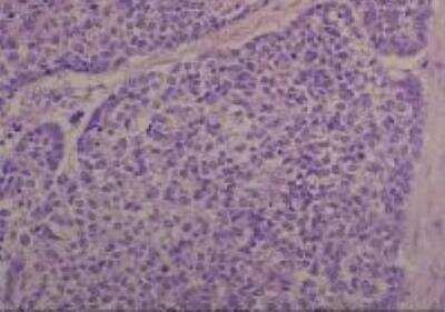 Hematoxylin & Eosin Stain: Human Common Tissue MicroArray (Cancer) [NBP2-30262] - 18. Esophagus, basaloid squamous cell carcinoma