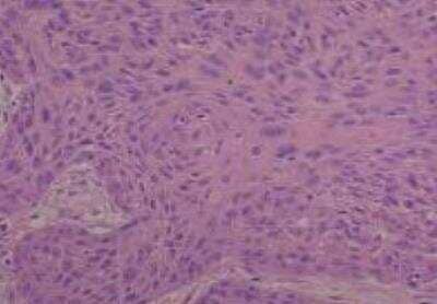 Hematoxylin & Eosin Stain: Human Common Tissue MicroArray (Cancer) [NBP2-30262] - 20. Esophogus squamous cell carcinoma