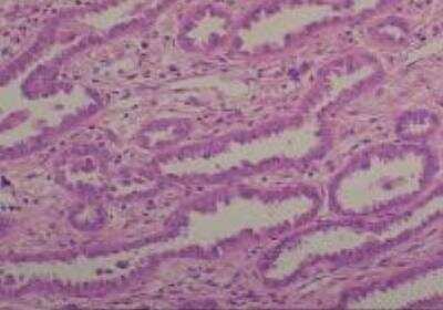 Hematoxylin & Eosin Stain: Human Common Tissue MicroArray (Cancer) [NBP2-30262] -  21. Lung adenocarcinoma