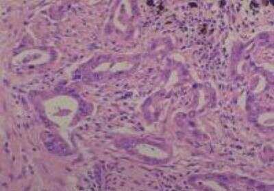 Hematoxylin & Eosin Stain: Human Common Tissue MicroArray (Cancer) [NBP2-30262] -  26. Lung adenocarcinoma, Well differentiated