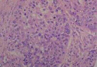 Hematoxylin & Eosin Stain: Human Common Tissue MicroArray (Cancer) [NBP2-30262] - 28. Lung squamous cell carcinoma, Moderately differentiated