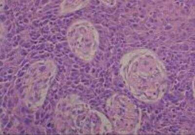 Hematoxylin & Eosin Stain: Human Common Tissue MicroArray (Cancer) [NBP2-30262] - - 29. Lung squamous cell carcinoma, W/D