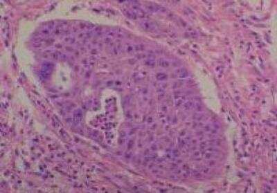 Hematoxylin & Eosin Stain: Human Common Tissue MicroArray (Cancer) [NBP2-30262] -  32. Rectum adenocarcinoma, Moderately differentiated