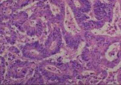 Hematoxylin & Eosin Stain: Human Common Tissue MicroArray (Cancer) [NBP2-30262] -  34. Ascending colon adenocarcinoma, well differentiated