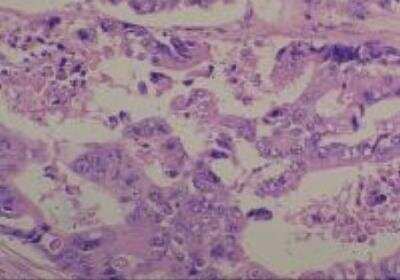 Hematoxylin & Eosin Stain: Human Common Tissue MicroArray (Cancer) [NBP2-30262] -  38. Ascending colon Adenocarcinoma