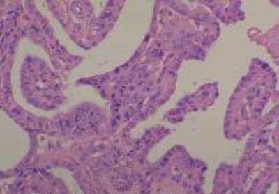 Hematoxylin & Eosin Stain: Human Common Tissue MicroArray (Cancer) [NBP2-30262] -  49. Thyroid papillary carcinoma