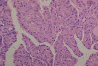 Hematoxylin & Eosin Stain: Human Common Tissue MicroArray (Cancer) [NBP2-30262] - 50. Thyroid papillary carcinoma